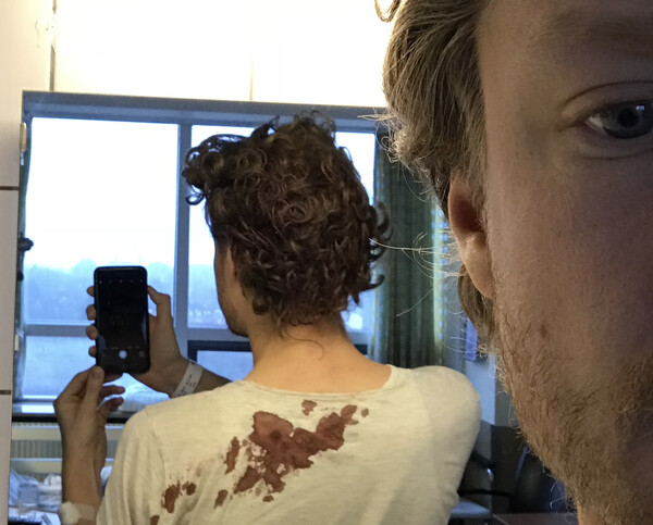 Blood from my head on my shirt as photographed from the hospital room.